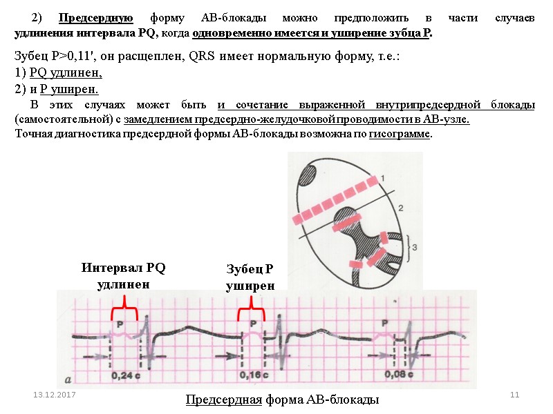 2) Предсердную форму АВ-блокады можно предположить в части случаев удлинения интервала PQ, когда одновременно